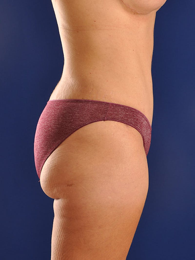 Abdominoplasty / Tummy Tuck Before & After Gallery - Patient 18242320 - Image 6