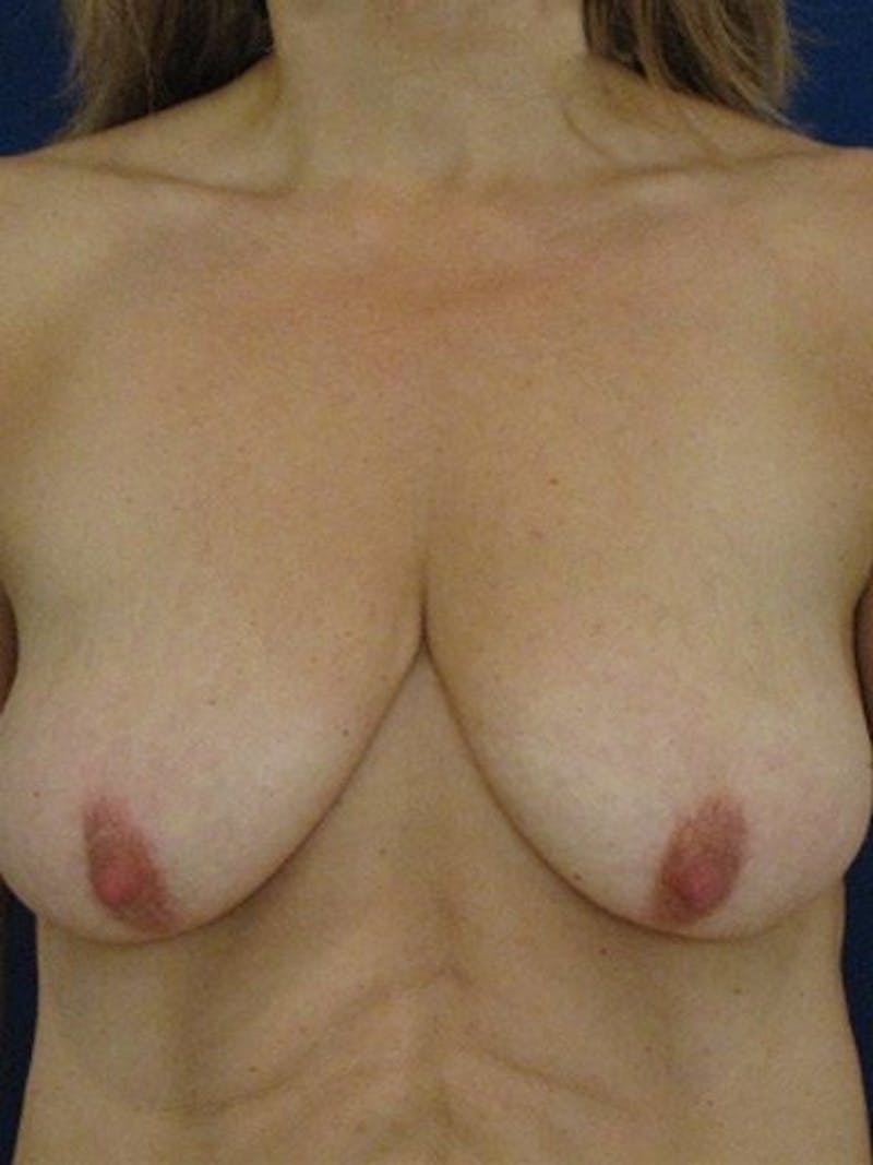 Breast Lift With Augmentation Before & After Gallery - Patient 18242322 - Image 1