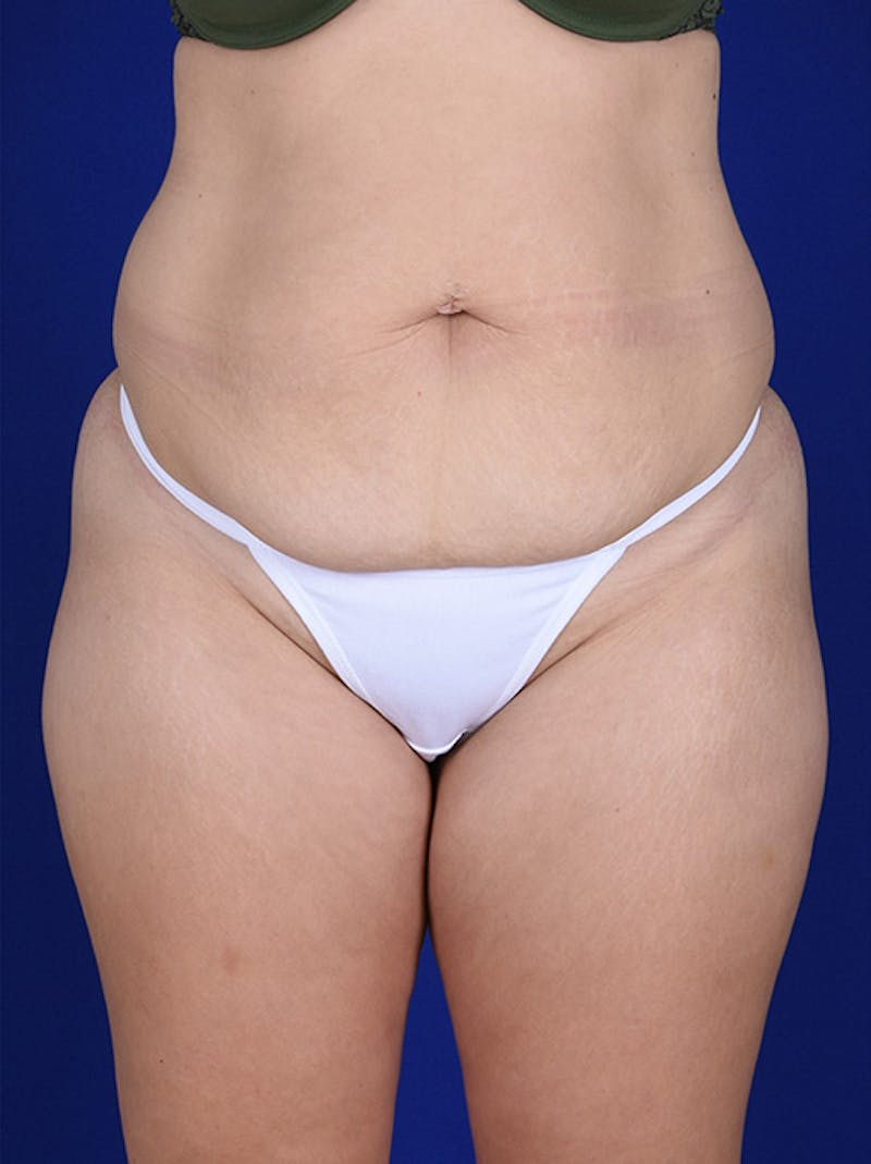 Abdominoplasty / Tummy Tuck Before & After Gallery - Patient 18242324 - Image 1