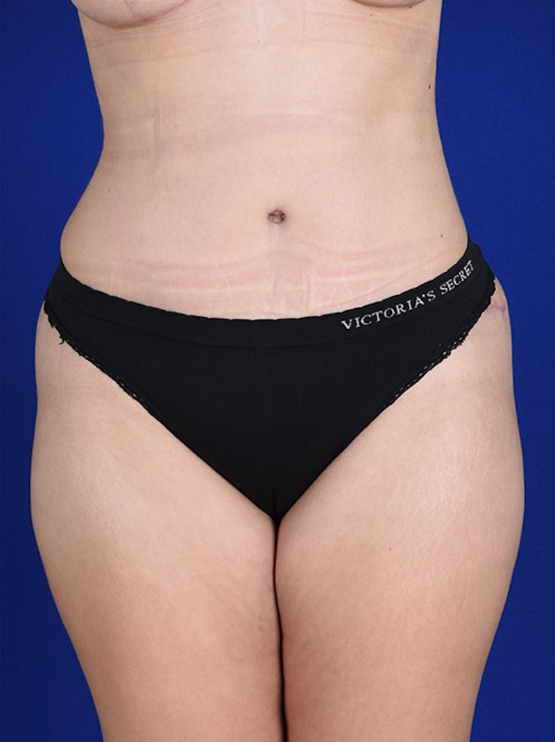 Abdominoplasty / Tummy Tuck Before & After Gallery - Patient 18242324 - Image 2