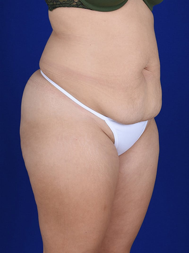 Abdominoplasty / Tummy Tuck Before & After Gallery - Patient 18242324 - Image 3