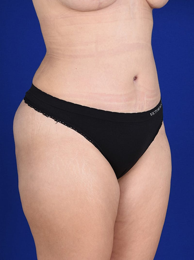 Abdominoplasty / Tummy Tuck Before & After Gallery - Patient 18242324 - Image 4