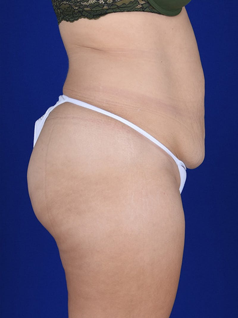 Abdominoplasty / Tummy Tuck Before & After Gallery - Patient 18242324 - Image 5