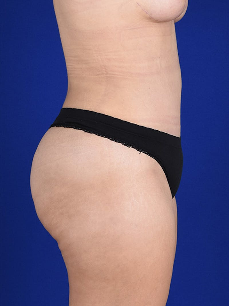 Abdominoplasty / Tummy Tuck Before & After Gallery - Patient 18242324 - Image 6