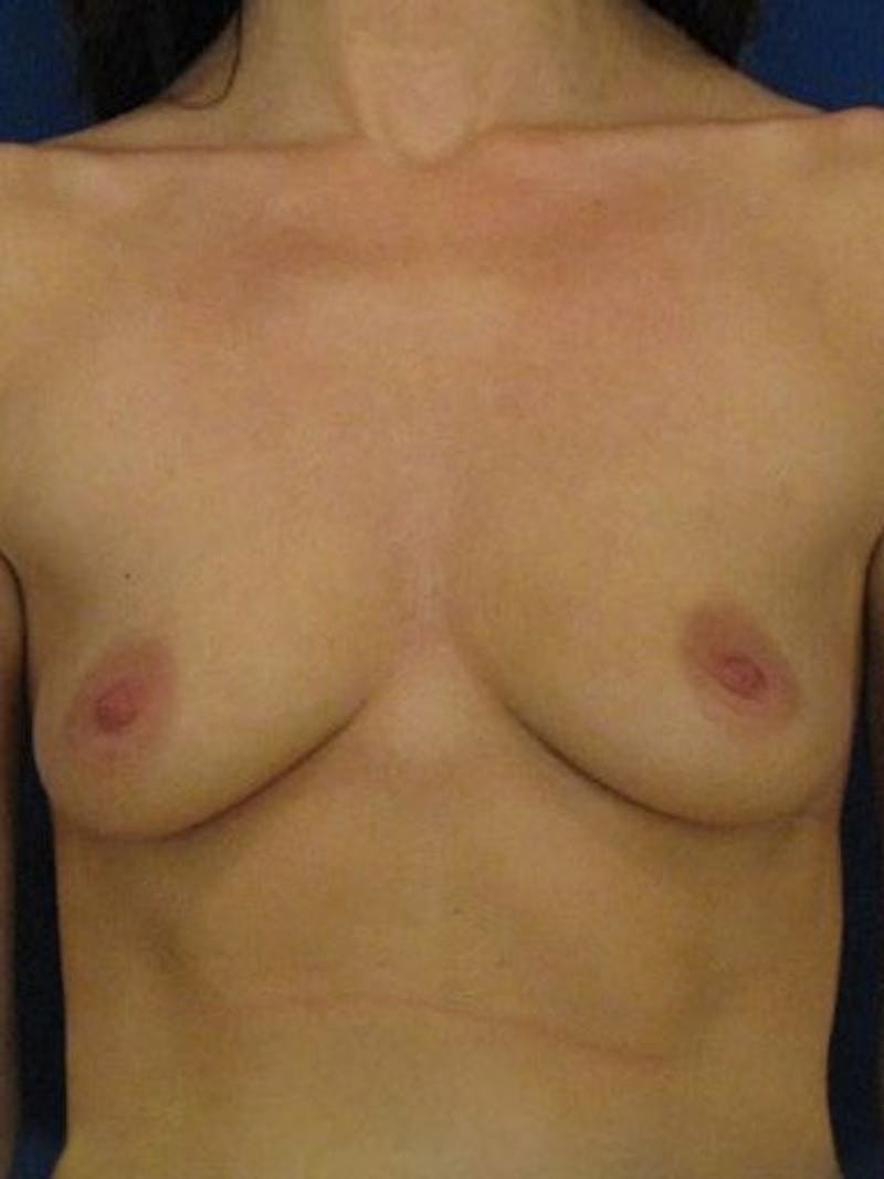 Breast Augmentation Before & After Gallery - Patient 18242327 - Image 1