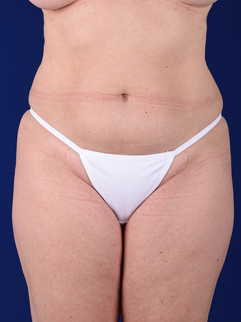 Abdominoplasty / Tummy Tuck Before & After Gallery - Patient 18242328 - Image 1
