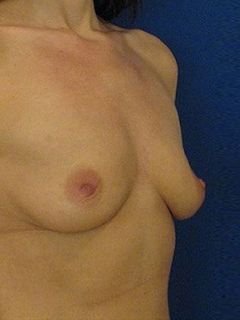 Breast Augmentation Before & After Gallery - Patient 18242327 - Image 3