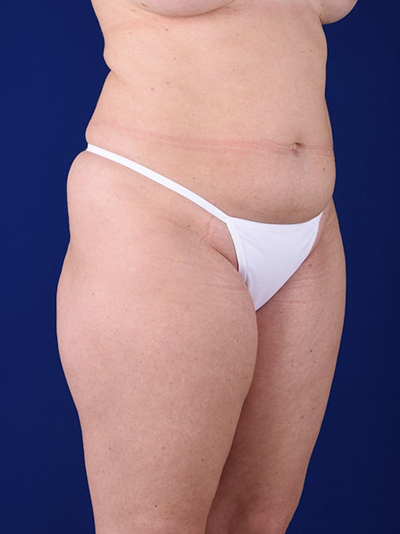 Abdominoplasty / Tummy Tuck Before & After Gallery - Patient 18242328 - Image 3