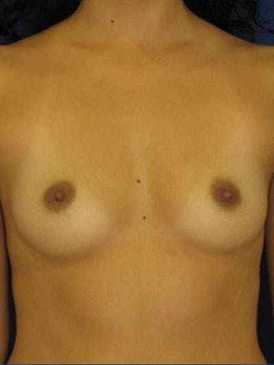 Breast Augmentation Before & After Gallery - Patient 18242329 - Image 1