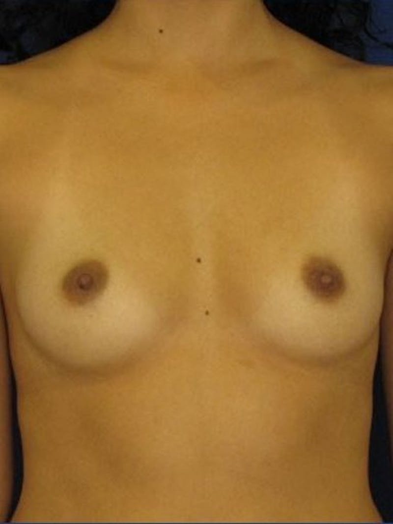 Breast Augmentation Before & After Gallery - Patient 18242329 - Image 1