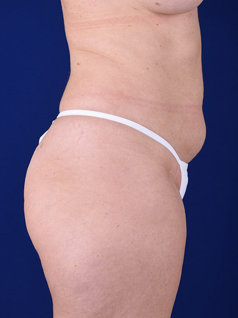 Abdominoplasty / Tummy Tuck Before & After Gallery - Patient 18242328 - Image 5