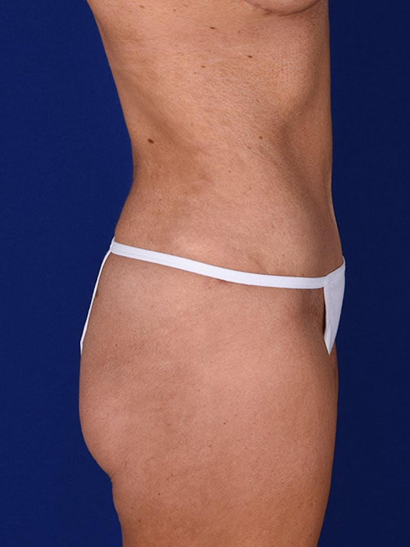 Abdominoplasty / Tummy Tuck Before & After Gallery - Patient 18242328 - Image 6
