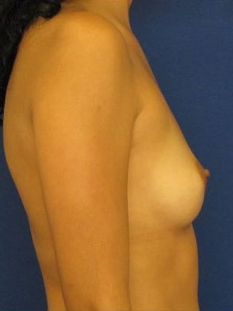 Breast Augmentation Before & After Gallery - Patient 18242329 - Image 3