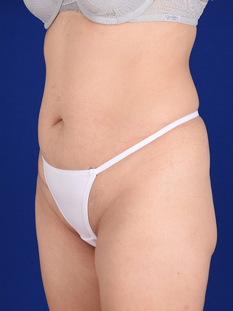 Abdominoplasty / Tummy Tuck Before & After Gallery - Patient 18242332 - Image 3
