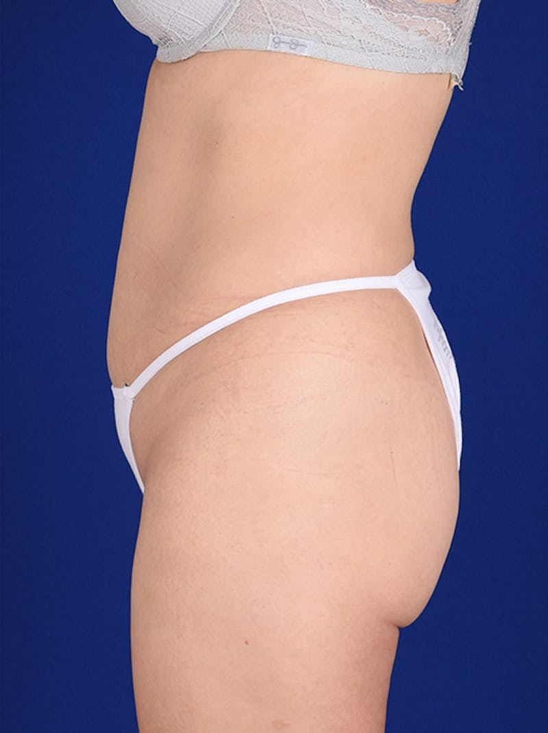 Abdominoplasty / Tummy Tuck Before & After Gallery - Patient 18242332 - Image 5