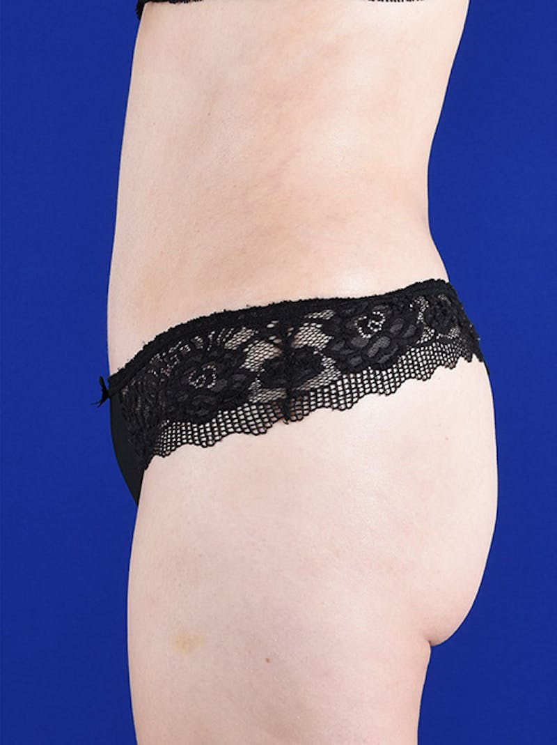 Abdominoplasty / Tummy Tuck Before & After Gallery - Patient 18242332 - Image 6