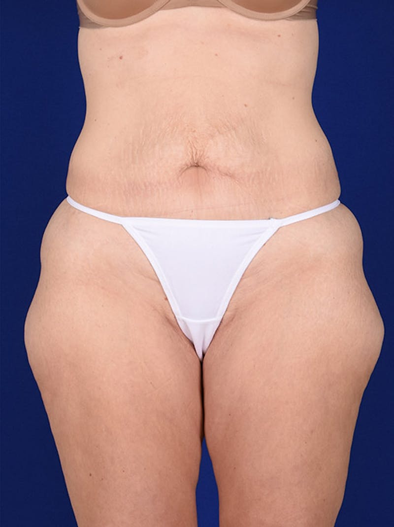 Abdominoplasty / Tummy Tuck Before & After Gallery - Patient 18242336 - Image 1