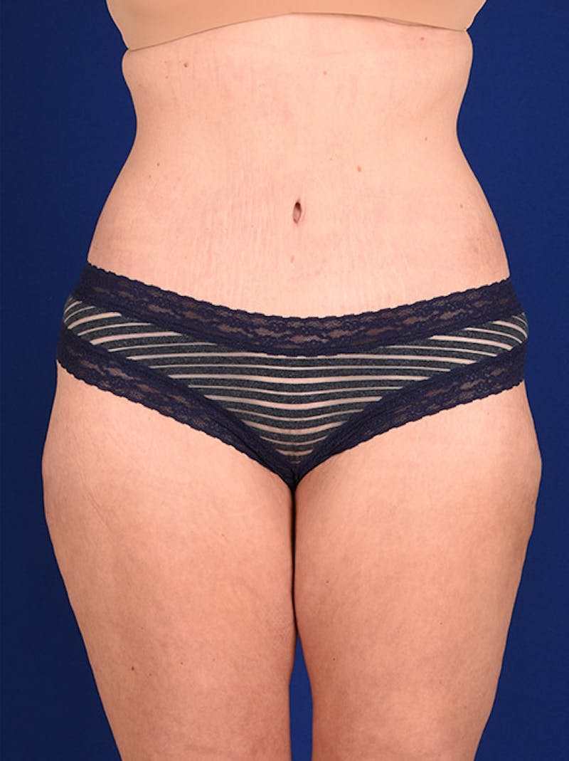 Abdominoplasty / Tummy Tuck Before & After Gallery - Patient 18242336 - Image 2