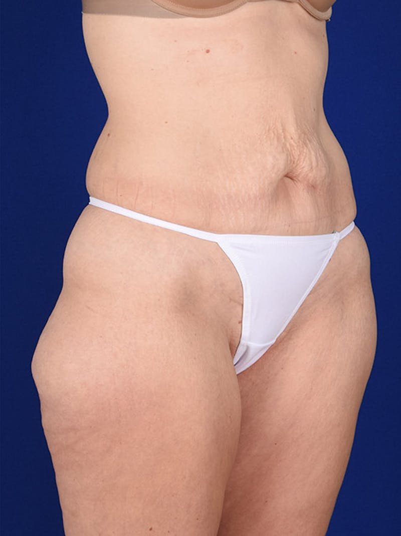Abdominoplasty / Tummy Tuck Before & After Gallery - Patient 18242336 - Image 3