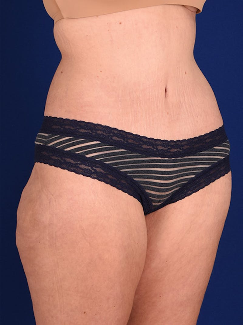 Abdominoplasty / Tummy Tuck Before & After Gallery - Patient 18242336 - Image 4
