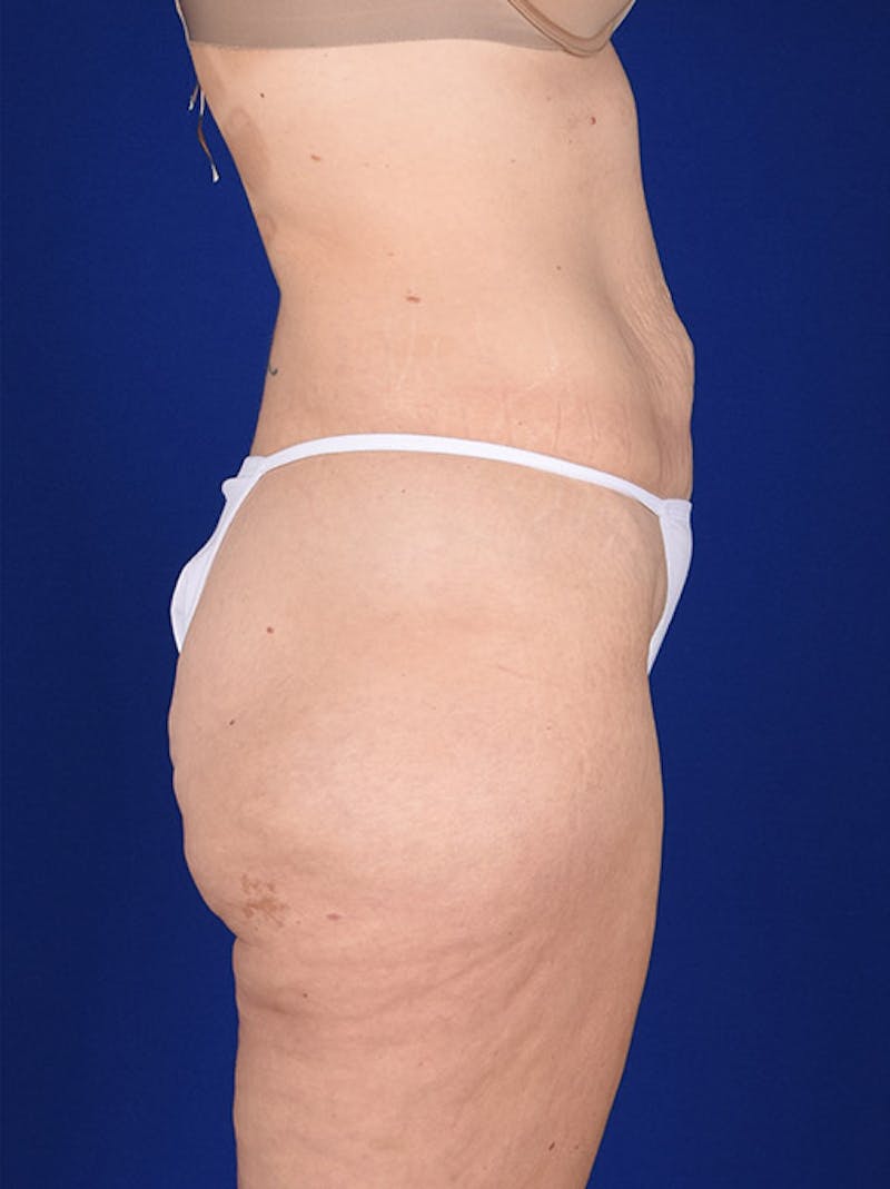 Abdominoplasty / Tummy Tuck Before & After Gallery - Patient 18242336 - Image 5