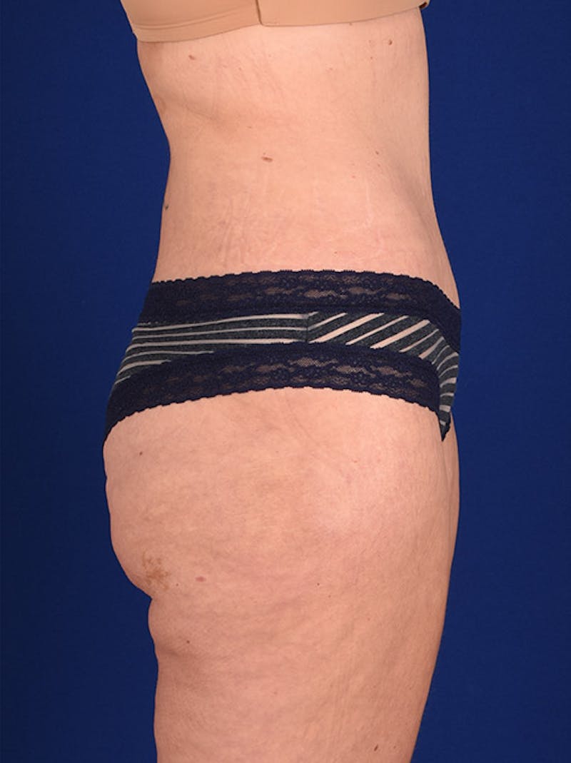 Abdominoplasty / Tummy Tuck Before & After Gallery - Patient 18242336 - Image 6