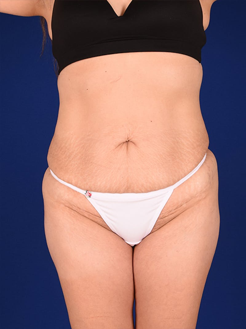 Abdominoplasty / Tummy Tuck Before & After Gallery - Patient 18242343 - Image 1