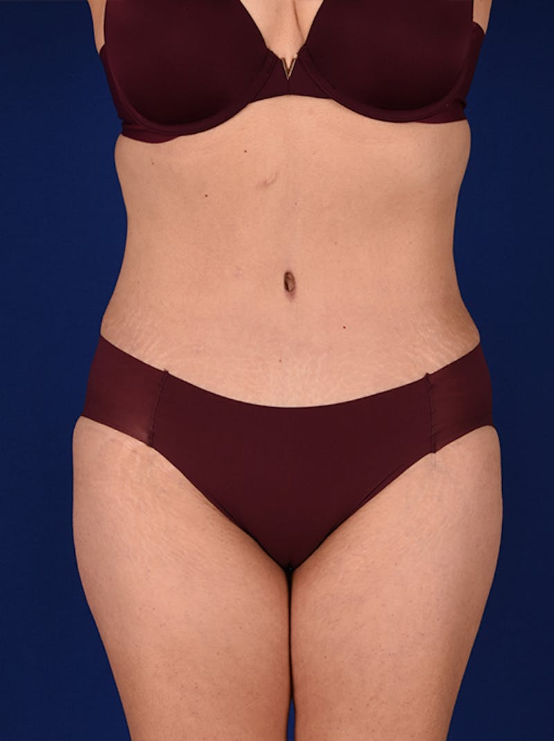 Abdominoplasty / Tummy Tuck Before & After Gallery - Patient 18242343 - Image 2