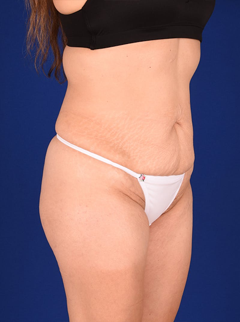 Abdominoplasty / Tummy Tuck Before & After Gallery - Patient 18242343 - Image 3