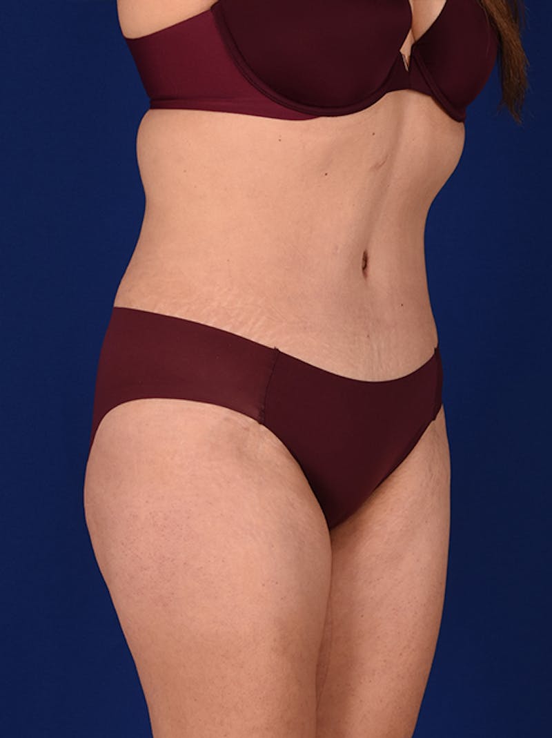 Abdominoplasty / Tummy Tuck Before & After Gallery - Patient 18242343 - Image 4
