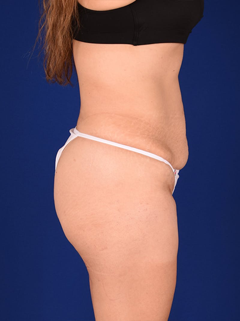 Abdominoplasty / Tummy Tuck Before & After Gallery - Patient 18242343 - Image 5