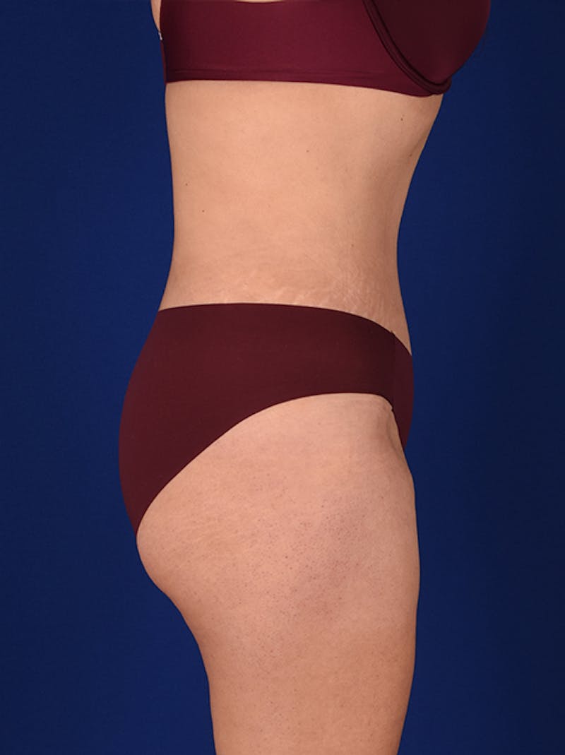 Abdominoplasty / Tummy Tuck Before & After Gallery - Patient 18242343 - Image 6