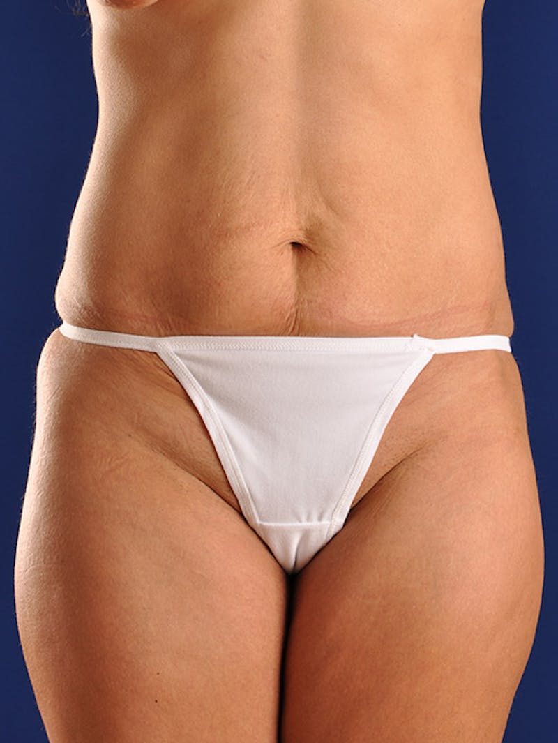 Abdominoplasty / Tummy Tuck Before & After Gallery - Patient 18242348 - Image 1