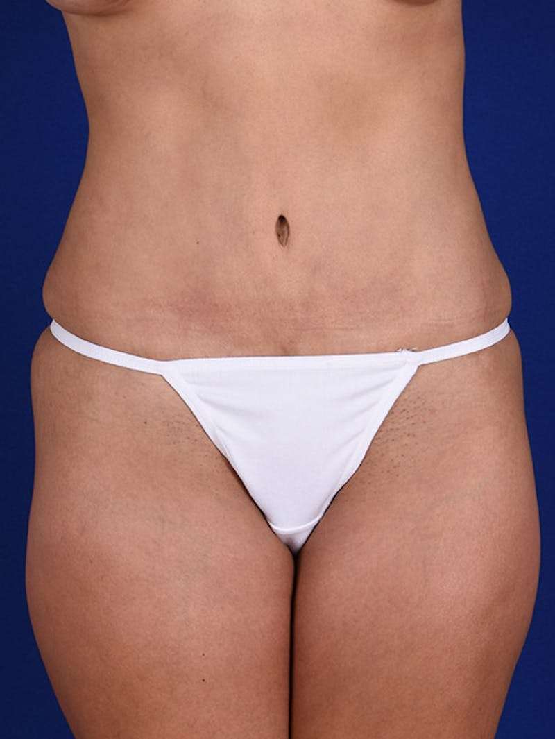 Abdominoplasty / Tummy Tuck Before & After Gallery - Patient 18242348 - Image 2