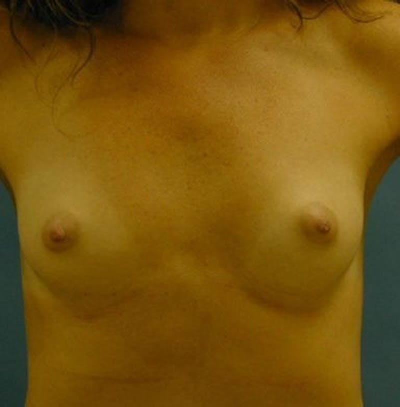 Breast Augmentation Before & After Gallery - Patient 18242349 - Image 1