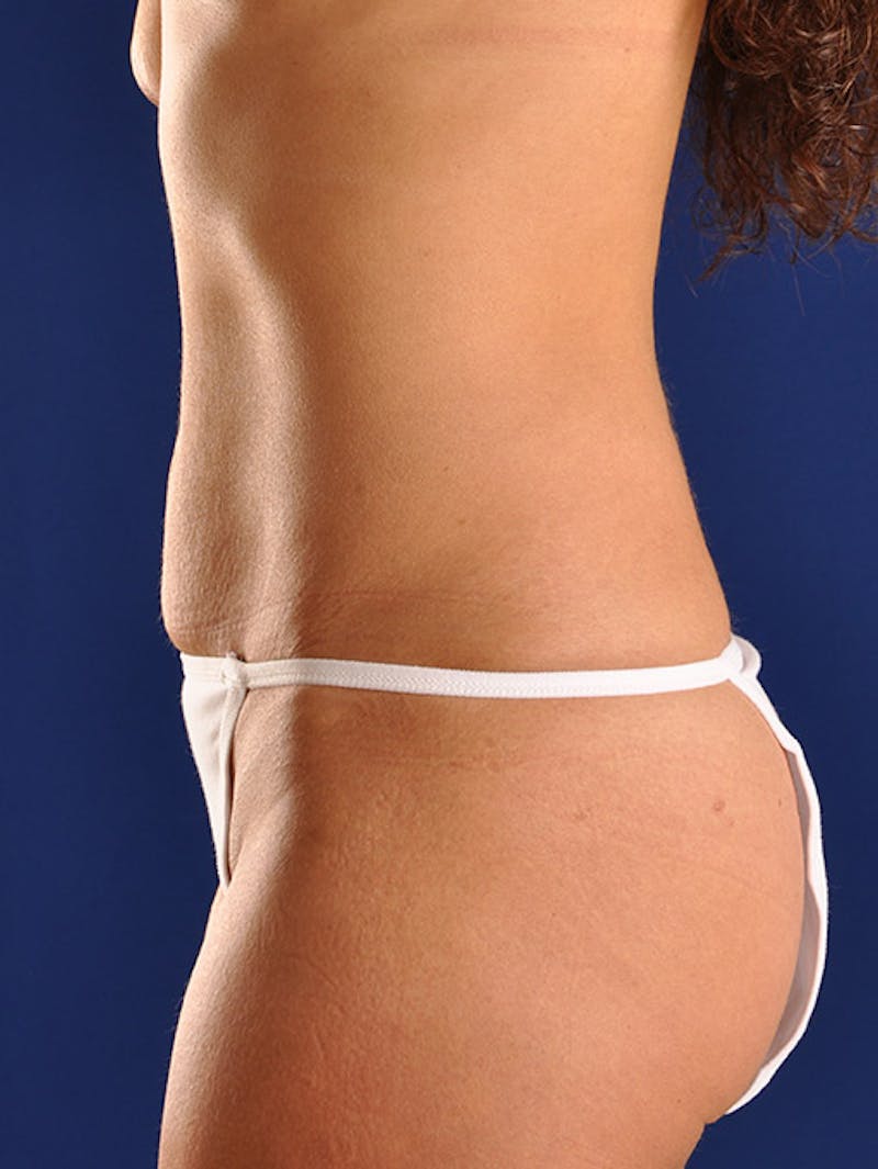 Abdominoplasty / Tummy Tuck Before & After Gallery - Patient 18242348 - Image 5