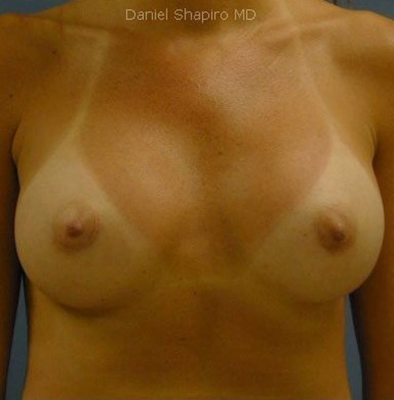Breast Augmentation Before & After Gallery - Patient 18242349 - Image 2