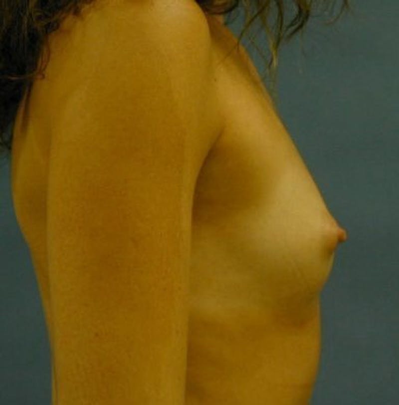 Breast Augmentation Before & After Gallery - Patient 18242349 - Image 3