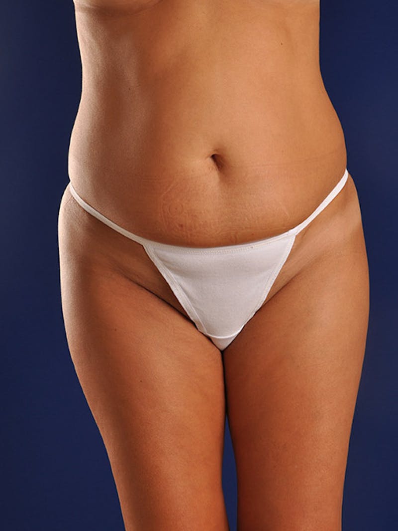 Abdominoplasty / Tummy Tuck Before & After Gallery - Patient 18242351 - Image 1