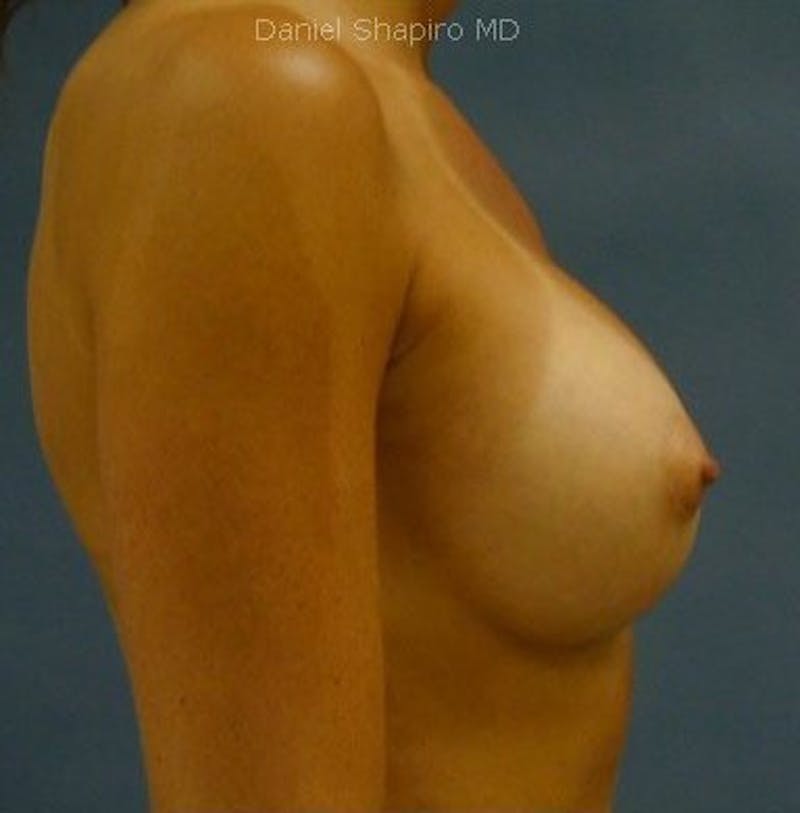 Breast Augmentation Before & After Gallery - Patient 18242349 - Image 4