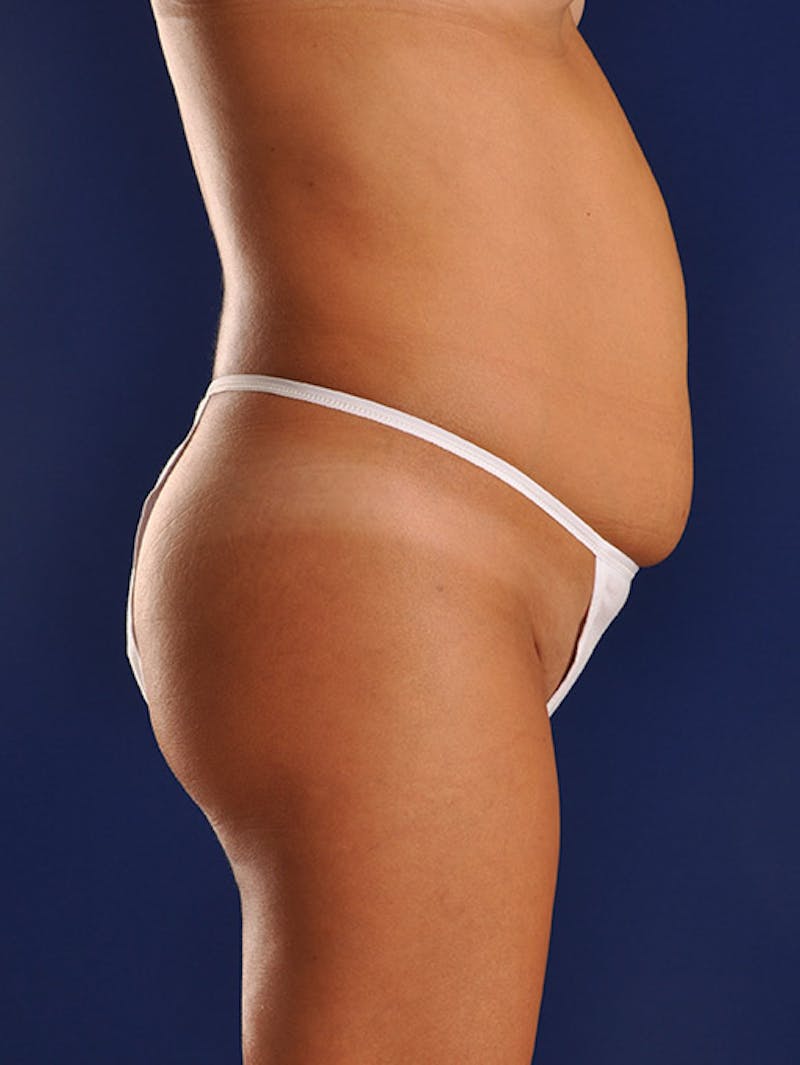 Abdominoplasty / Tummy Tuck Before & After Gallery - Patient 18242351 - Image 5