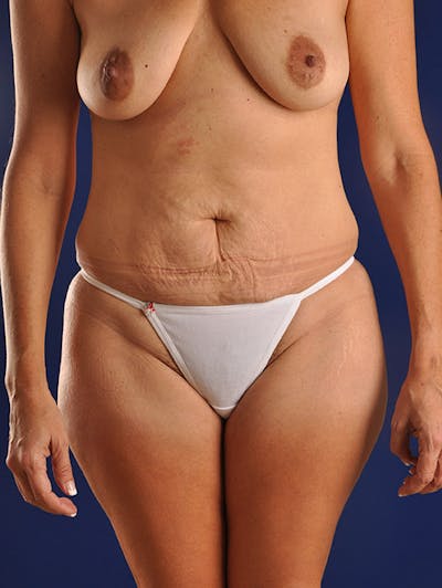 Mommy Makeover Before & After Gallery - Patient 18242352 - Image 1