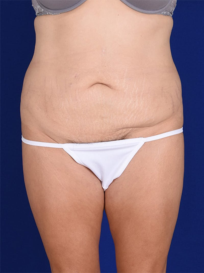 Abdominoplasty / Tummy Tuck Before & After Gallery - Patient 18242353 - Image 1