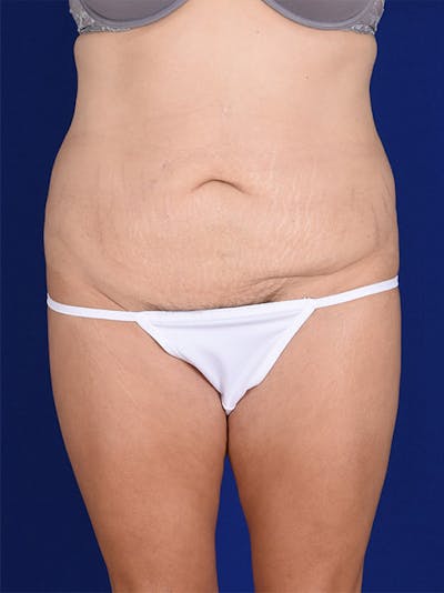 Abdominoplasty / Tummy Tuck Before & After Gallery - Patient 18242353 - Image 1