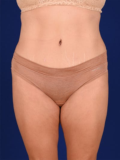 Abdominoplasty / Tummy Tuck Before & After Gallery - Patient 18242353 - Image 2