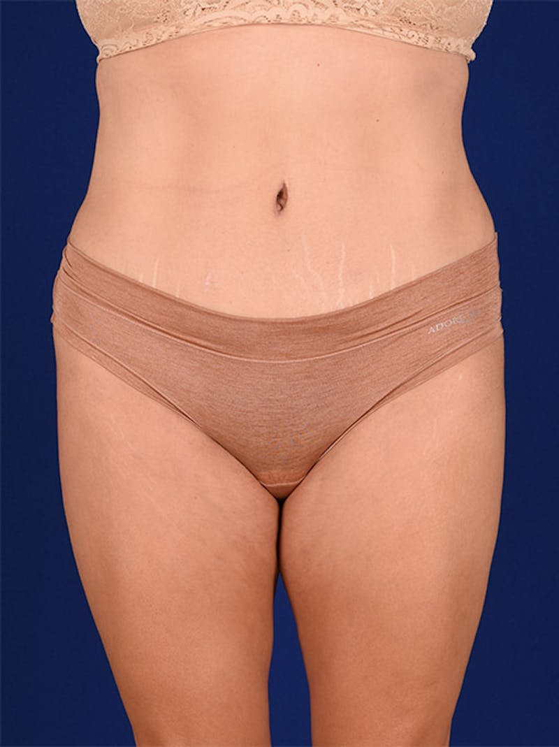 Abdominoplasty / Tummy Tuck Before & After Gallery - Patient 18242353 - Image 2