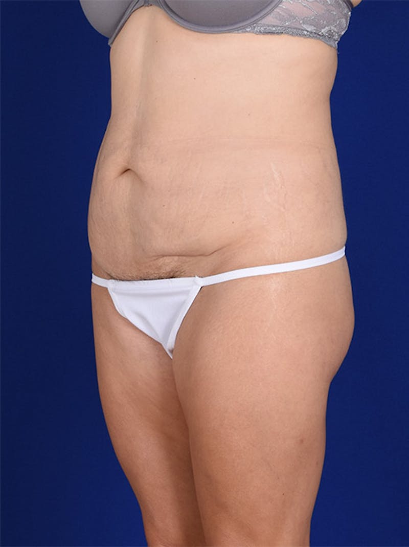 Abdominoplasty / Tummy Tuck Before & After Gallery - Patient 18242353 - Image 3