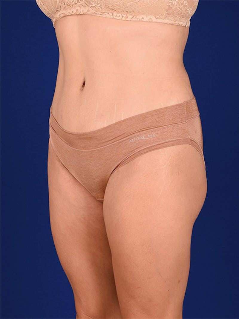Abdominoplasty / Tummy Tuck Before & After Gallery - Patient 18242353 - Image 4