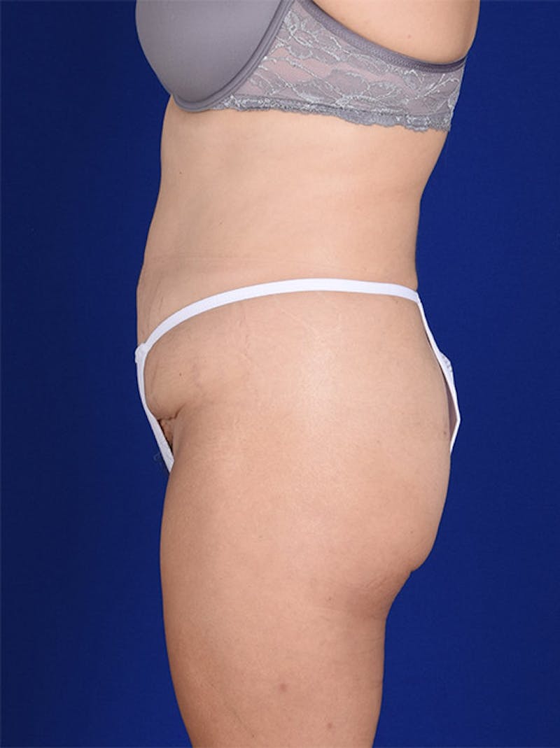 Abdominoplasty / Tummy Tuck Before & After Gallery - Patient 18242353 - Image 5