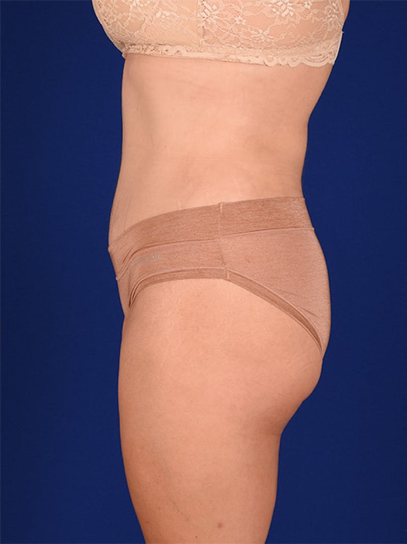 Abdominoplasty / Tummy Tuck Before & After Gallery - Patient 18242353 - Image 6